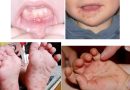 Warga Sungai Kecil Bintan Resah, Kasus “Flu Singapura” Mulai Merebak